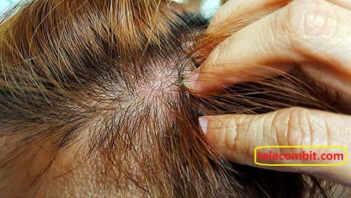 What drives the hives of the scalp? Tips To Say Goodbye To Sensitive Scalp Irritation Hair