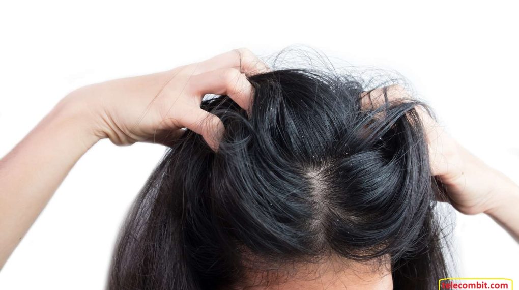 Can yeast build-up spoil your scalp? Tips To Say Goodbye To Sensitive Scalp Irritation Hair