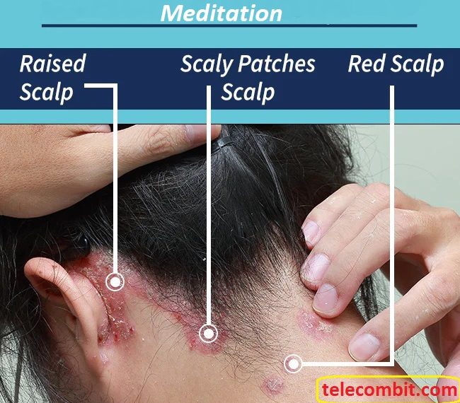 Meditation Tips To Say Goodbye To Sensitive Scalp Irritation Hair