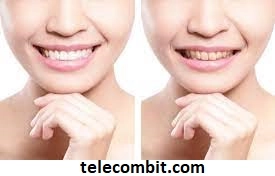 Tips for Practical Herbaluxy Teeth Whitening-telecombit.com